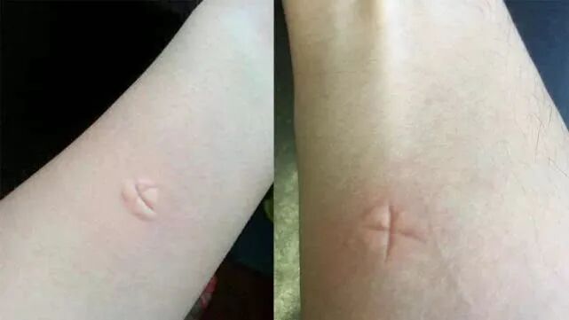 被蚊子叮了就“掐十字”!到底管用吗? 被蚊子叮了就“掐十字”!到底管用吗?