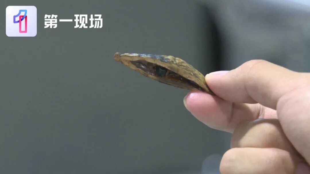 以为“上火了”,结果是癌!男子被切除半根舌头…医生紧急提醒 以为“上火了”,结果是癌!男子被切除半根舌头…医生紧急提醒