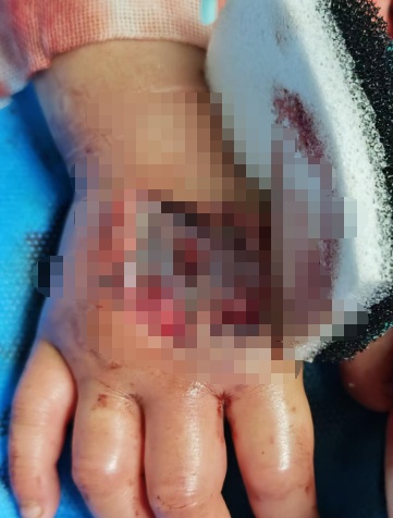 3岁女童在家中被毒蛇咬伤,“假死”3天奇迹生还 3岁女童在家中被毒蛇咬伤,“假死”3天奇迹生还