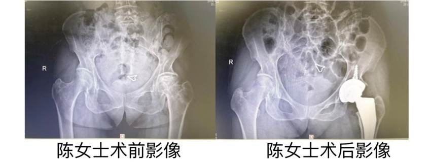 股骨头坏死盯上中青年，医生提醒：酗酒和骨折带来“双重暴击”