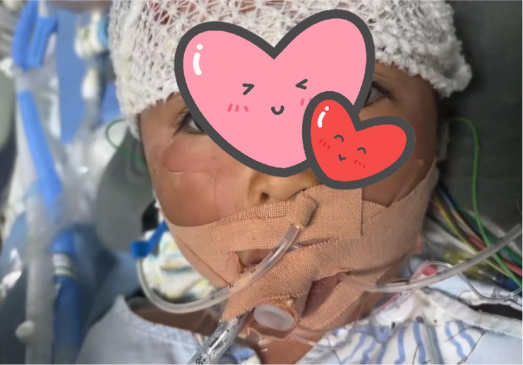 3岁女童在家中被毒蛇咬伤,“假死”3天奇迹生还 3岁女童在家中被毒蛇咬伤,“假死”3天奇迹生还