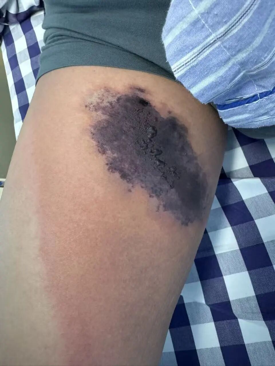 旧牛仔裤藏毒蜘蛛,男子穿上被咬一口差点“全身中毒”! 旧牛仔裤藏毒蜘蛛,男子穿上被咬一口差点“全身中毒”!