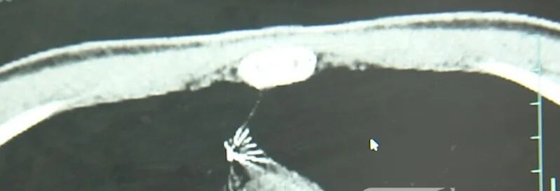 17岁小伙参军体检,发现胸腔内有根5cm缝衣针 17岁小伙参军体检,发现胸腔内有根5cm缝衣针