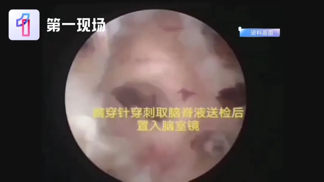 23岁女孩头痛，硬扛7天后心脏停跳，ICU里开颅3次，仍昏迷未醒！元凶几乎家家都有