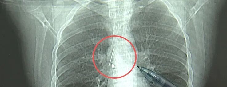 17岁小伙参军体检,发现体内有根金属针,位置极其凶险!父母回忆或是1岁时扎入 17岁小伙参军体检,发现体内有根金属针,位置极其凶险!父母回忆或是1岁时扎入