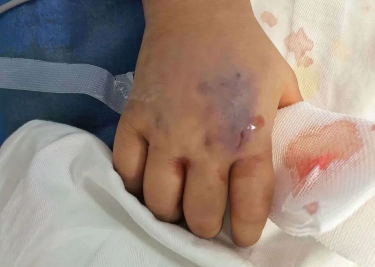 3岁女童在家中被毒蛇咬伤,“假死”3天奇迹生还 3岁女童在家中被毒蛇咬伤,“假死”3天奇迹生还