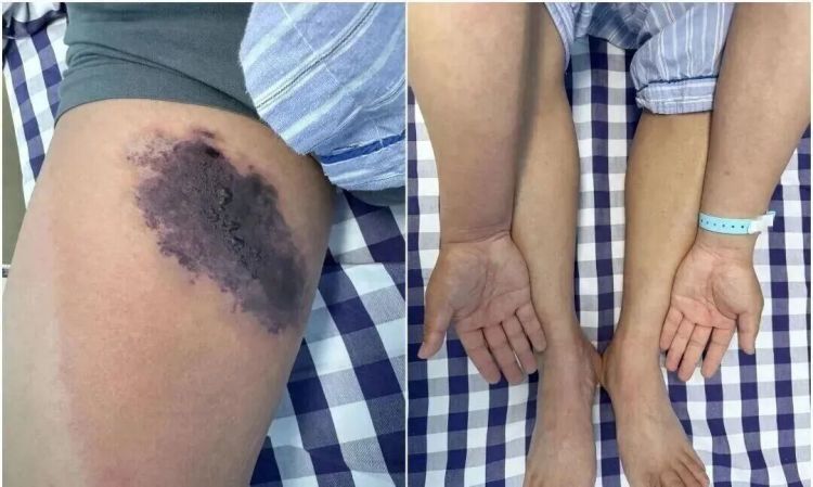 男子翻出旧牛仔裤穿，差点出现“全身中毒”，提醒：千万别大意