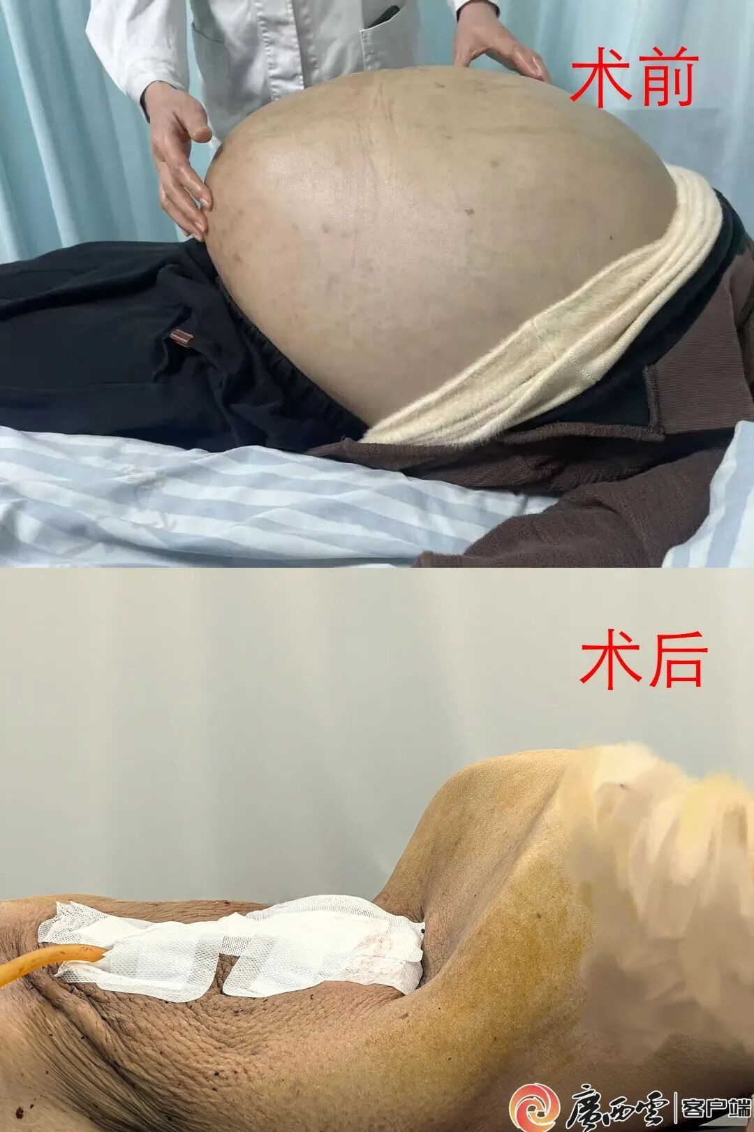 失忆流浪25年,女子腹中藏45公斤肿瘤!手术前她写下遗嘱:不要为难医生 失忆流浪25年,女子腹中藏45公斤肿瘤!手术前她写下遗嘱:不要为难医生