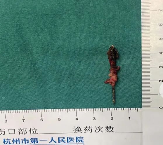 17岁小伙参军体检,发现胸腔内有根5cm缝衣针 17岁小伙参军体检,发现胸腔内有根5cm缝衣针