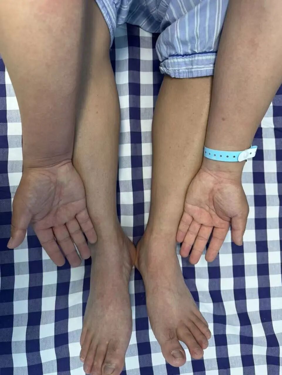 旧牛仔裤藏毒蜘蛛,男子穿上被咬一口差点“全身中毒”! 旧牛仔裤藏毒蜘蛛,男子穿上被咬一口差点“全身中毒”!