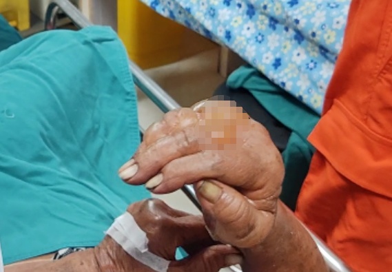 老人手部“爬”满水泡，状如鸽子蛋！医生紧急求助消防员