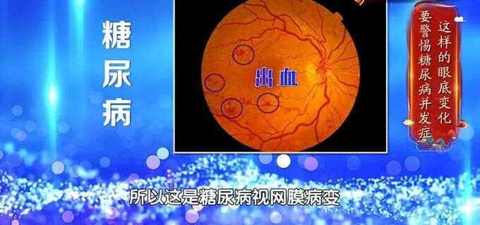 血管要出事，眼睛先报警，出现这种信号，再拖就是脑梗、失明了