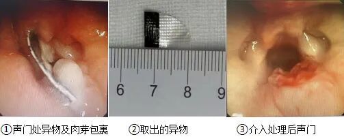 山东一名8个月宝宝差点儿窒息，“杀手”竟然是家长常忽视的它