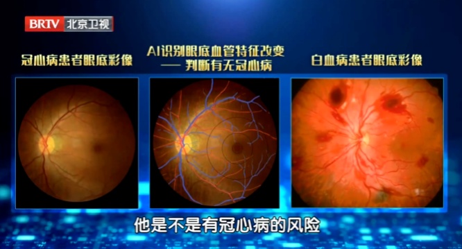 血管要出事，眼睛先报警，出现这种信号，再拖就是脑梗、失明了