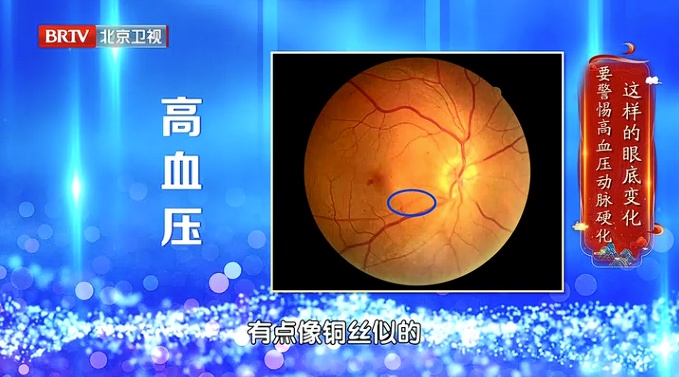 血管要出事，眼睛先报警，出现这种信号，再拖就是脑梗、失明了