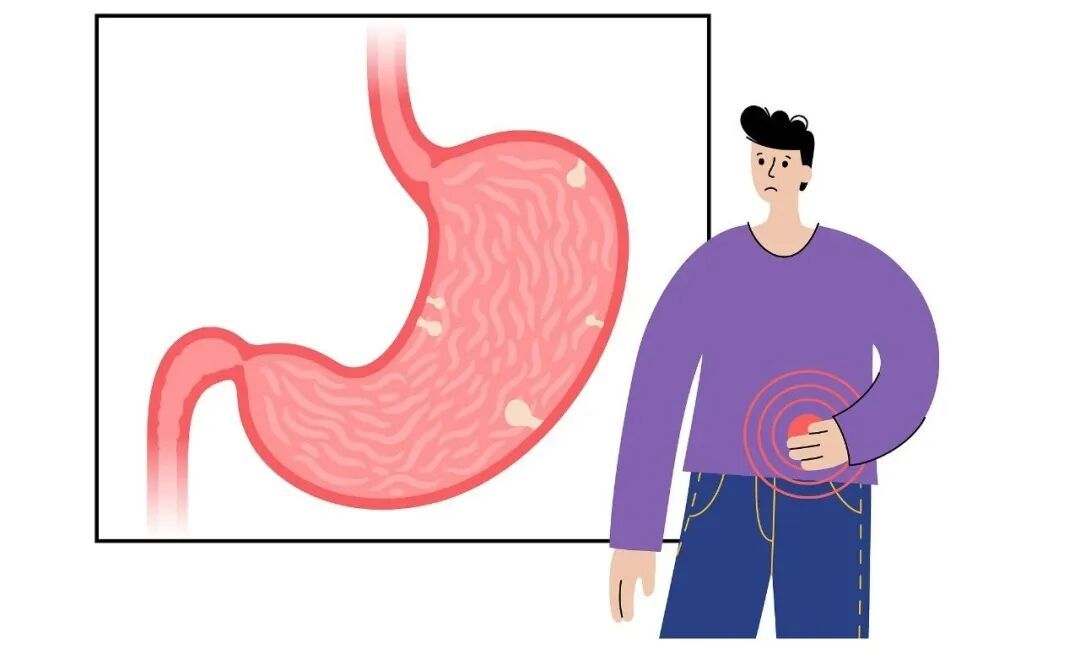 体检查出息肉怎么办？大多数是良性，但有一种几乎100%会癌变