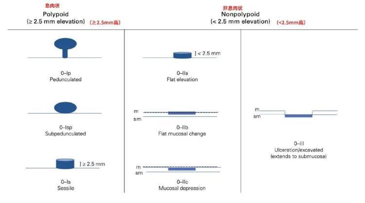 体检发现“息肉”别慌 一文读懂哪些会癌变、哪些不用切