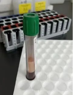 杭州一男子抽出“草莓奶油血”!肚子胀成“铅球”,这些坏习惯很多人也有… 杭州一男子抽出“草莓奶油血”!肚子胀成“铅球”,这些坏习惯很多人也有…