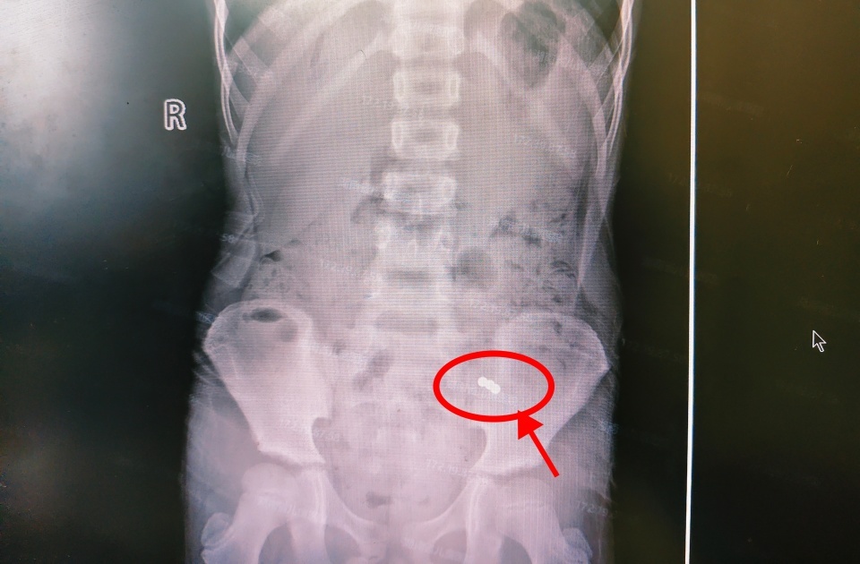 9岁男孩误吞3颗磁珠，致肠管2处穿孔，医生紧急提醒