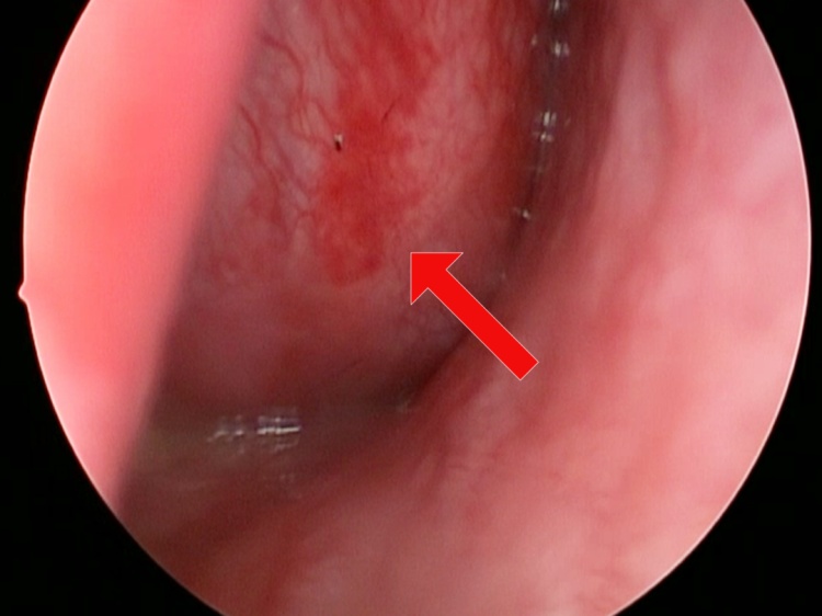 17岁少年鼻塞3年，反复流鼻血，医生一查：不是鼻炎，是肿瘤！