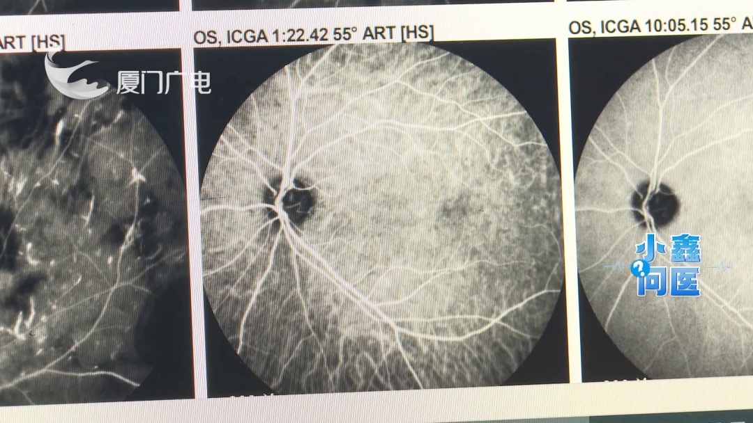 45岁女子自行打美容针,右眼突然失明!医生:已不可逆 45岁女子自行打美容针,右眼突然失明!医生:已不可逆
