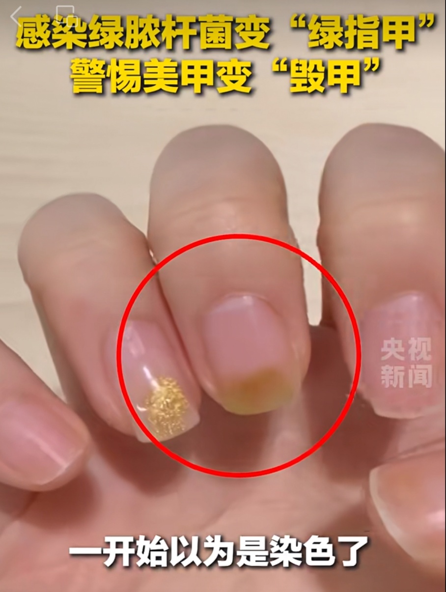 震惊！女子长出"绿指甲"，竟是感染霉变了！医生提醒️