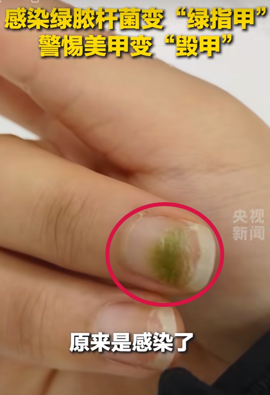 震惊！女子长出"绿指甲"，竟是感染霉变了！医生提醒️