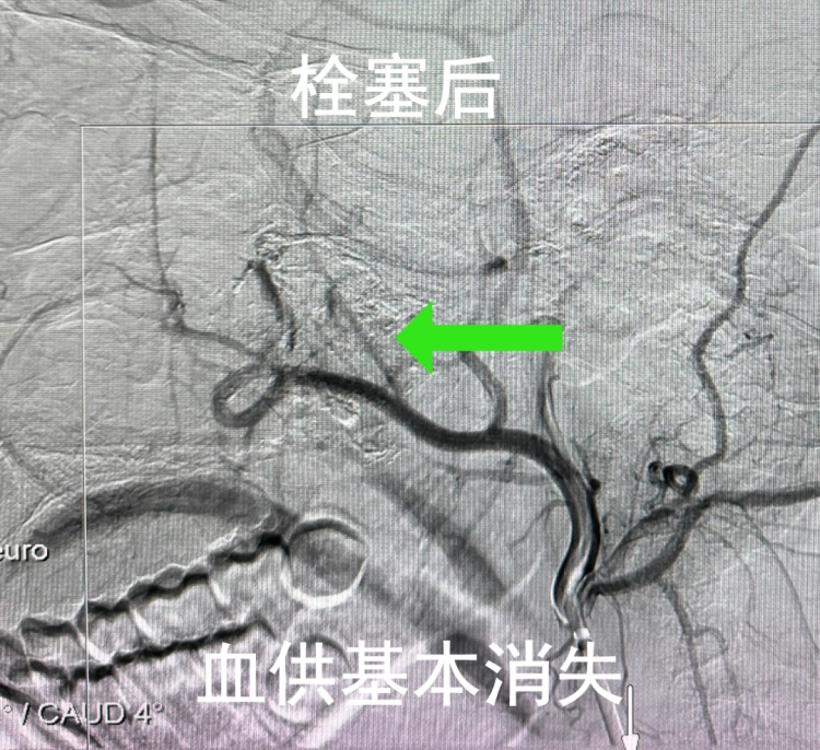 17岁少年鼻塞3年，反复流鼻血，医生一查：不是鼻炎，是肿瘤！