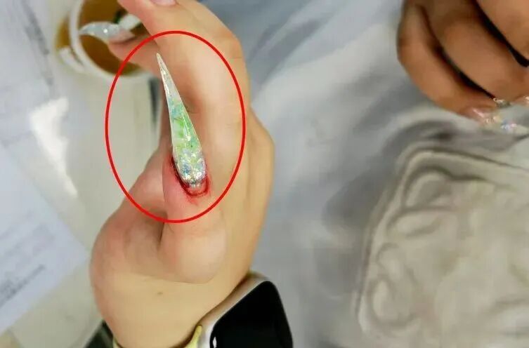 震惊！女子长出"绿指甲"，竟是感染霉变了！医生提醒️