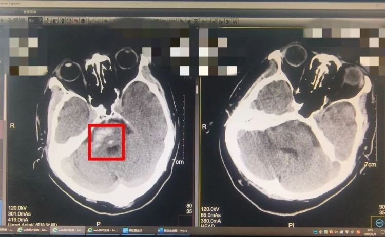 “我以为没事……”却在下车瞬间，左手“失灵”、说不出话，差点没命！