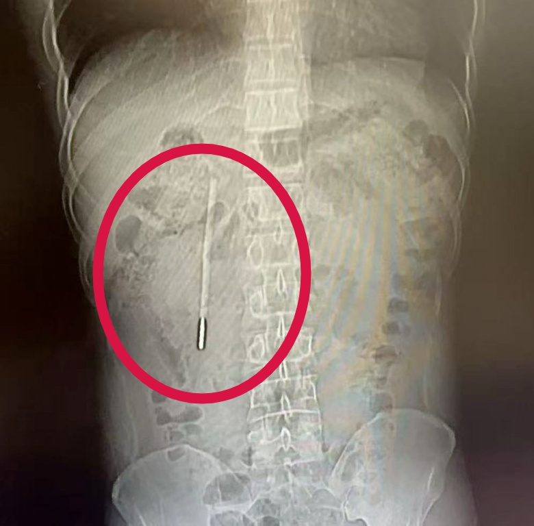男子腹痛就医，竟取出20年前吞下的体温计！还是完好的…