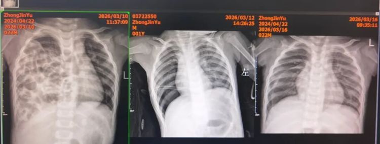 1岁娃反复咳嗽10天,医生:肺都快被肠子“挤没了”! 1岁娃反复咳嗽10天,医生:肺都快被肠子“挤没了”!