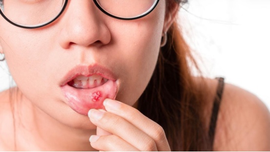 嘴巴疼千万别硬扛，这种“小毛病”拖着不治，可能要命