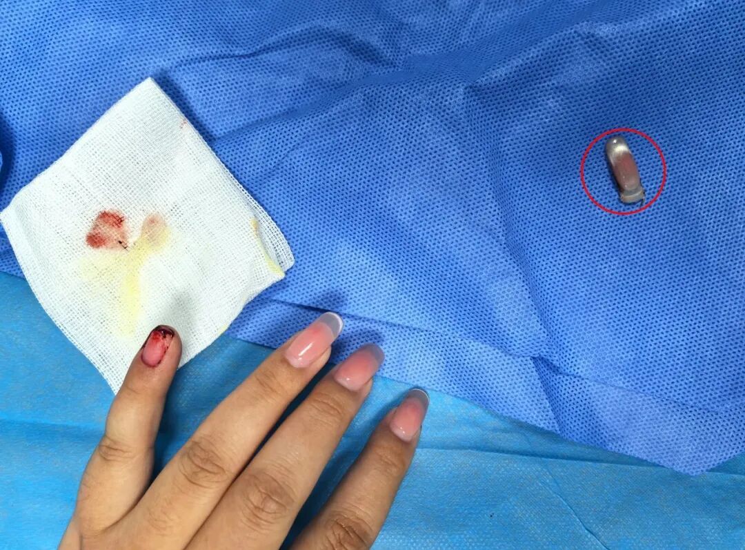 震惊！女子长出"绿指甲"，竟是感染霉变了！医生提醒️