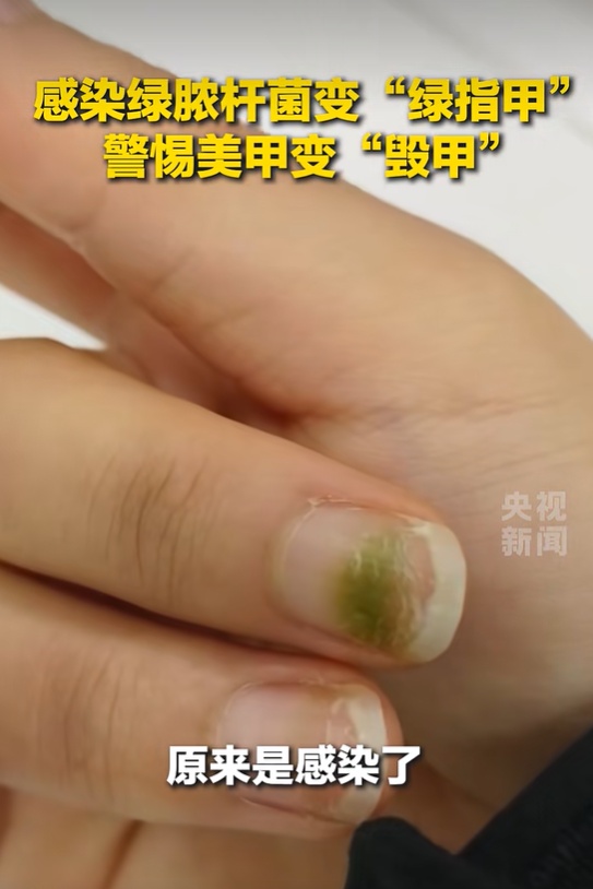 有人长出“绿指甲”！现在赶紧看看你的指甲盖→