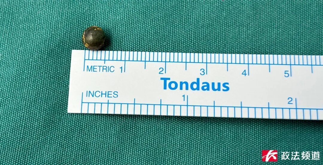 奶奶误扣射钉枪,钢珠射入孙子颅内!医生紧急提醒 奶奶误扣射钉枪,钢珠射入孙子颅内!医生紧急提醒