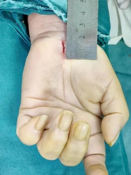 糖尿病患者长期手脚麻木?竟是血糖把身体的神经“隧道”堵住了 糖尿病患者长期手脚麻木?竟是血糖把身体的神经“隧道”堵住了