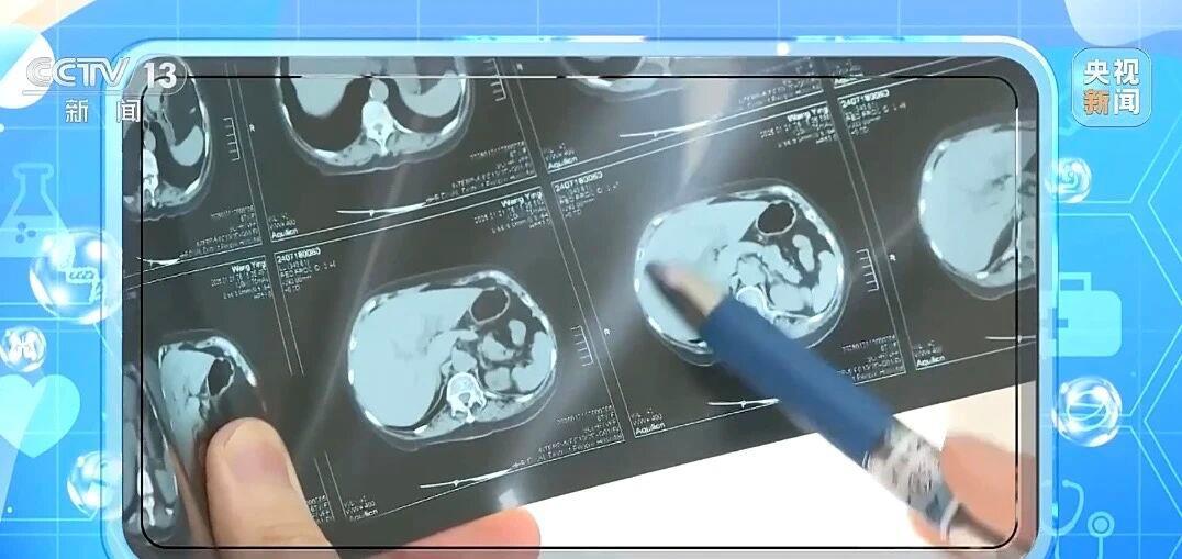 从胃炎到胃癌只有4步！出现这些症状别不当回事儿