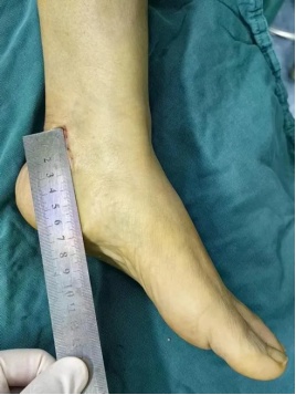 糖尿病患者长期手脚麻木?竟是血糖把身体的神经“隧道”堵住了 糖尿病患者长期手脚麻木?竟是血糖把身体的神经“隧道”堵住了