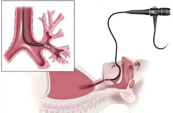 支气管还能洗？65岁大爷突发脑梗死气管被切开，医生通过“肺部大扫除”助其成功拔管