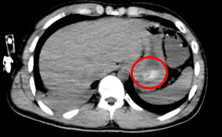 酒后吞下150片药，24岁男子险丧命！洗胃根本洗不掉…
