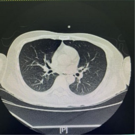 支气管还能洗？65岁大爷突发脑梗死气管被切开，医生通过“肺部大扫除”助其成功拔管