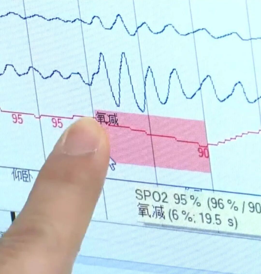 因扁桃体、腺样体肥大，10岁小孩睡觉打鼾 呼吸暂停44次