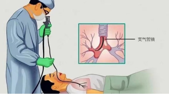 支气管还能洗？65岁大爷突发脑梗死气管被切开，医生通过“肺部大扫除”助其成功拔管