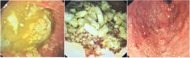 酒后吞下150片药，24岁男子险丧命！洗胃根本洗不掉…