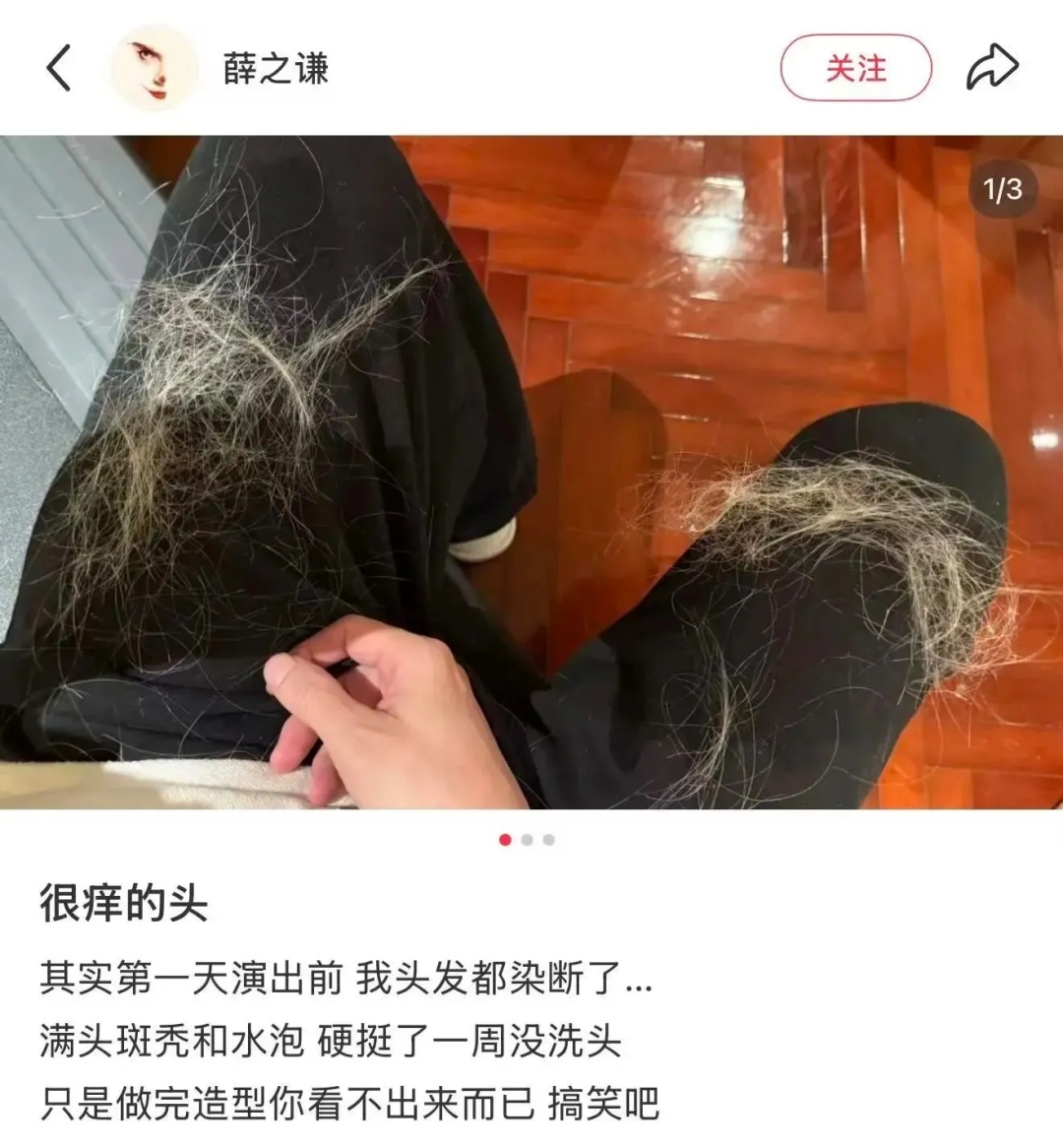 薛之谦晒满头斑秃水疱照,医生紧急提醒:一年染发别超4次 薛之谦晒满头斑秃水疱照,医生紧急提醒:一年染发别超4次