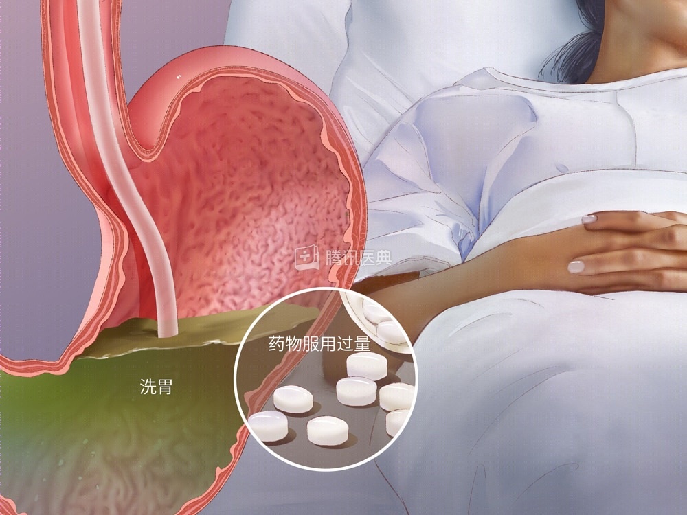 酒后吞下150片药，24岁男子险丧命！洗胃根本洗不掉…