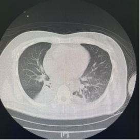 支气管还能洗？65岁大爷突发脑梗死气管被切开，医生通过“肺部大扫除”助其成功拔管