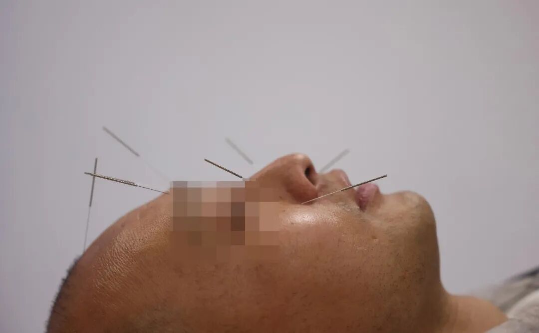 过敏性鼻炎，谁是罪魁