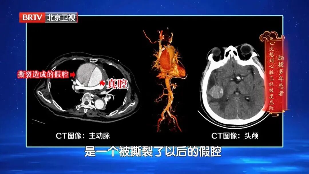 它是动脉硬化 “加速器”！伤心脏、毁大脑，这6类人更危险